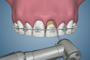 Maxillary Central Eruption